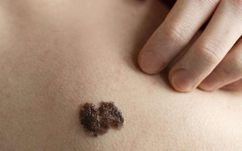 Free Skin Cancer Check at the Show